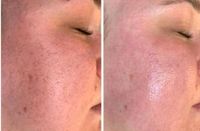 Microneedling Nordrhein-Westfalen - Alsdorf Vorschau