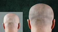 Haarpigmentierung nach Haartransplantation, FUE / FUT Narben, SMP München - Pasing-Obermenzing Vorschau