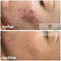 Microneedling Berlin - Marzahn Vorschau