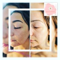 Microneedling Behandlung/Kosmetik/Beauty Nordrhein-Westfalen - Marienheide Vorschau