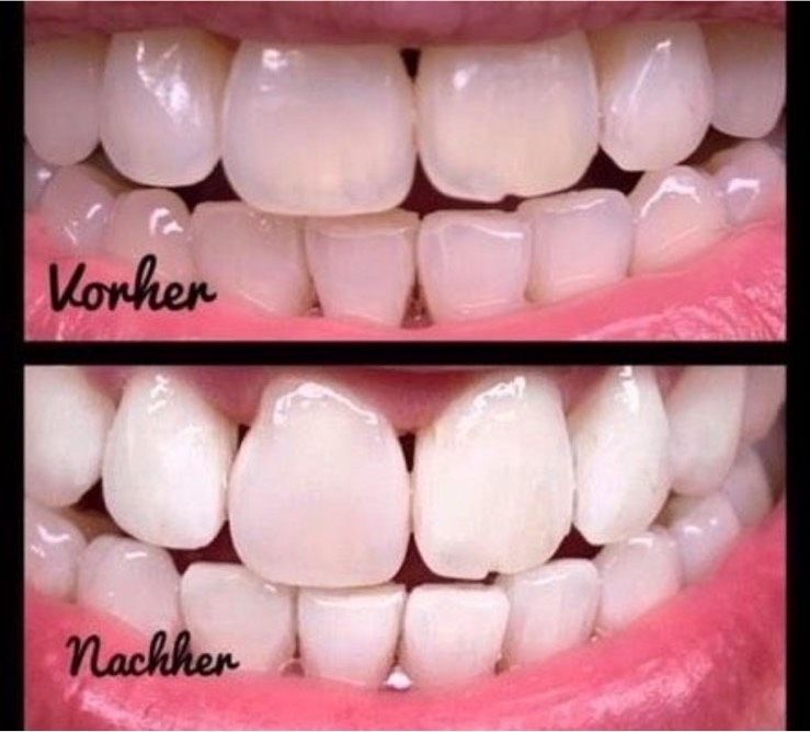 Zahnbleaching ~ Bleaching ~ Zähne in Seevetal