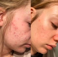 Aquafacial inklusive Microneedling Nordrhein-Westfalen - Herford Vorschau