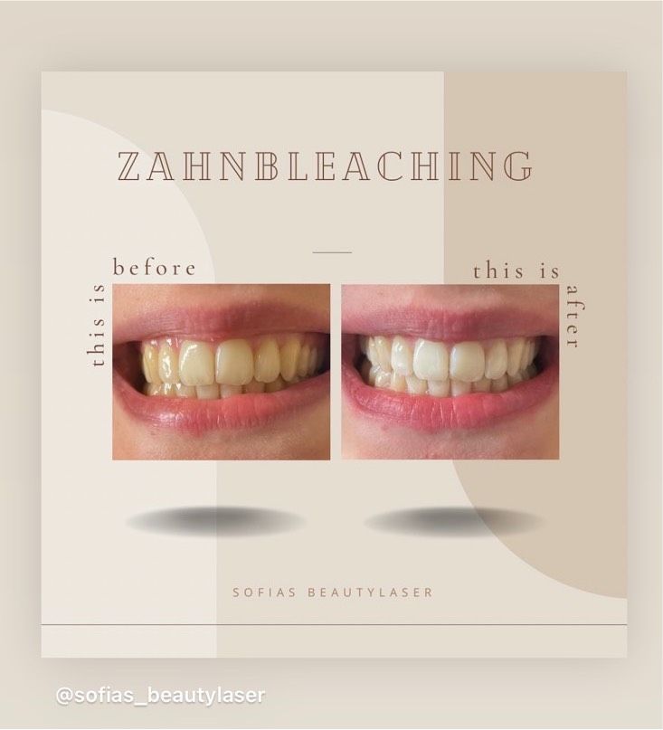 Zahnbleaching, Kosmetik Studio, Zahnaufhellung, helle Zähne in Kaltenkirchen