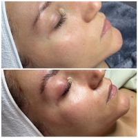 Kosmetikerin bbglow microneedling Aqua facial Lashlifting browlif Mülheim - Köln Buchforst Vorschau