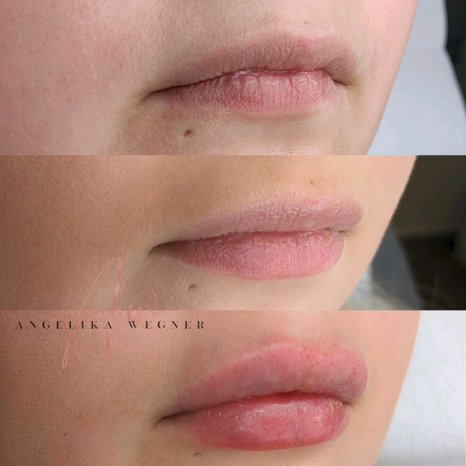 Lippenunterspritzung Faltenunterspritzung Hyaluron Pen in Uetze