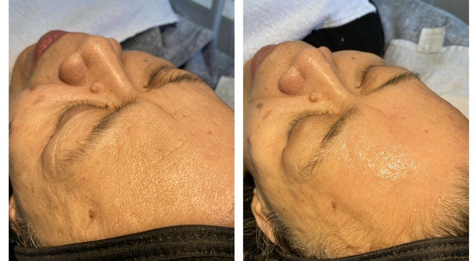 Microneedling für nur 99€! Duisburg in Duisburg