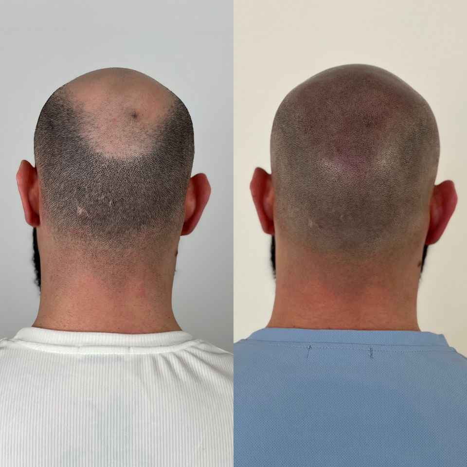 Haarpigmentierung SMP Haarpigmentation bei Haarausfall in Bersenbrück