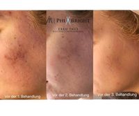 Microneedling inkl. Heimpflege ✔️ Bremen - Vegesack Vorschau