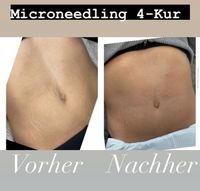 Microneedling 4-Kur Nordrhein-Westfalen - Detmold Vorschau