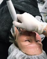 Microneedling Düsseldorf - Holthausen Vorschau