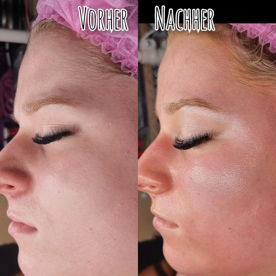 2 in1 Schulung BB Glow + Microneedling in Wadern