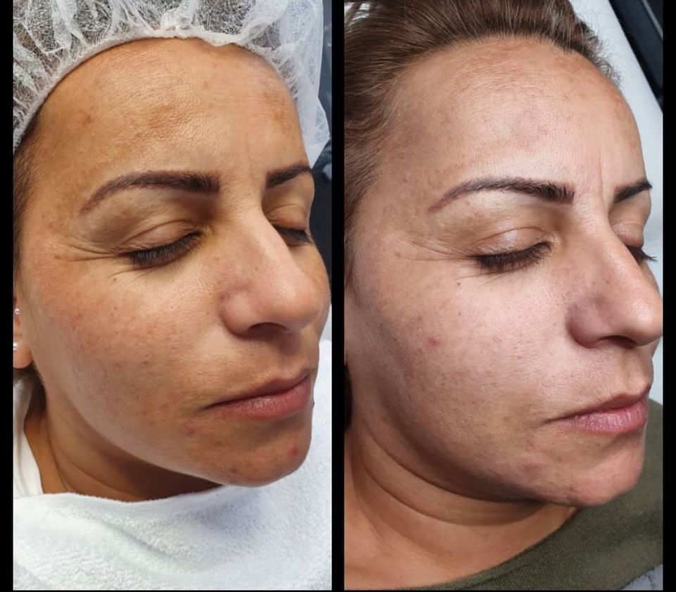 Professionelle Microneedling / BB-Glow Kombi Schulung in Flörsheim am Main