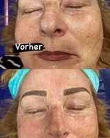 Microneedling Modelle gesucht Essen - Essen-Katernberg Vorschau