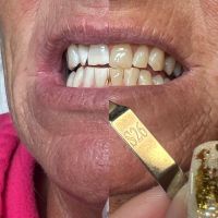 Kosmetische Zahnaufhellung Bayern - Roth Vorschau