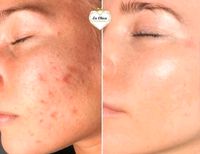 Microneedling, BB-GLOW, Faltenbehandlung, Kosmetikstudio Thüringen - Saalfeld (Saale) Vorschau