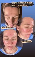 AKTION Aquafacial/Microneedling/ Gesichtsreinigung Nordrhein-Westfalen - Mönchengladbach Vorschau