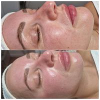 Microdermabrasion Wandsbek - Hamburg Bramfeld Vorschau