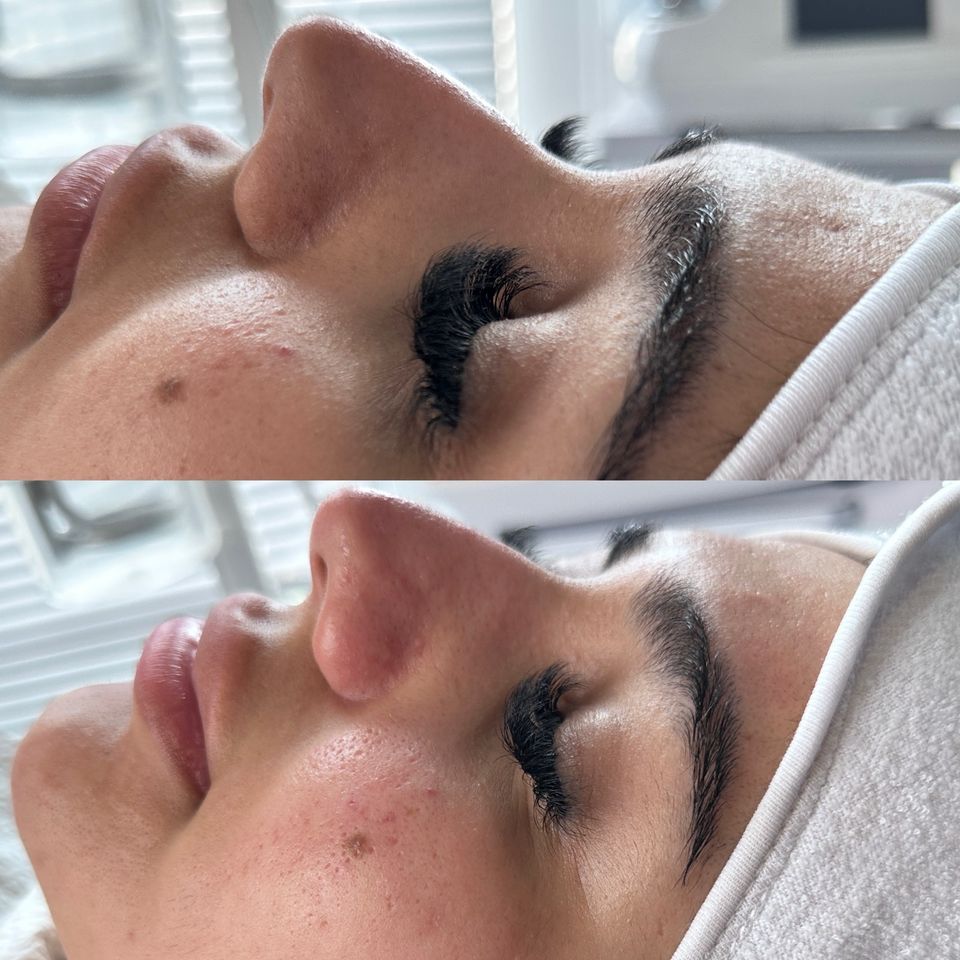 Aqua Facial Aquafacial Hydra Facial Hydrafacial Gesichtsbehandlug in Hamburg