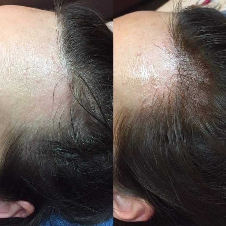 Hairline Microblading, optische Haarverdichtung in Bremen