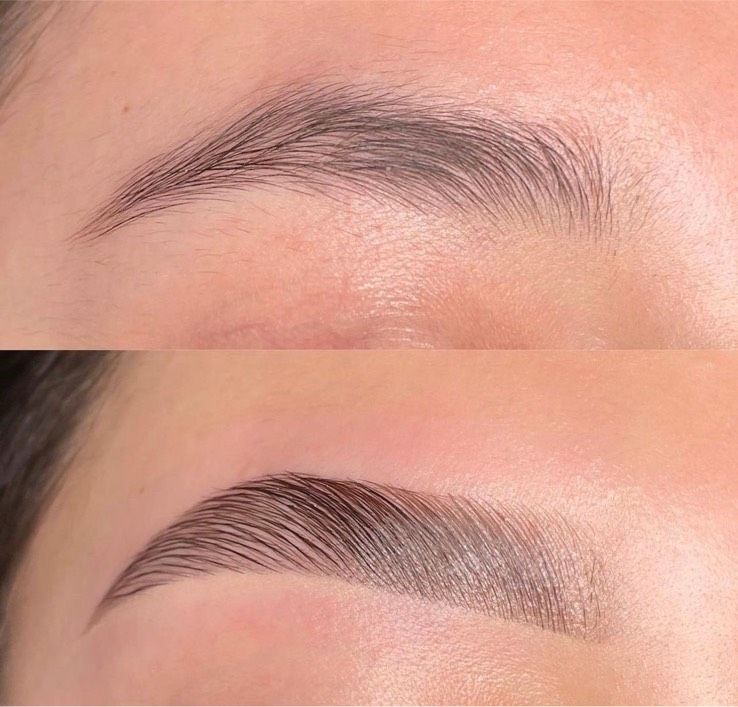 Brow Lifting in Gelsenkirchen