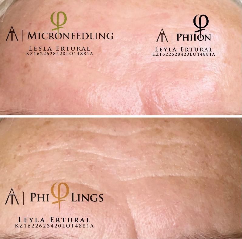 Microneedling Philings AntiAging PlasmaPen Akne  Kosmetik in Köln