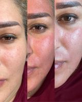 Microneedling ( phiBright)+ Pflege für zu Hause) Nordrhein-Westfalen - Heinsberg Vorschau