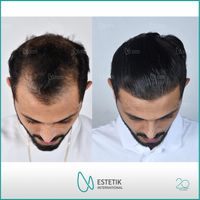 Haartransplantation in der Türkei / 1300€ inkl. Hotel und Transf. Essen - Essen-Stadtmitte Vorschau