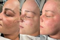 SIOSA Kosmetikstudio | Microneedling Nordrhein-Westfalen - Moers Vorschau