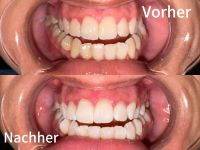 Kosmetische Zahnaufhellung Hessen - Rodgau Vorschau