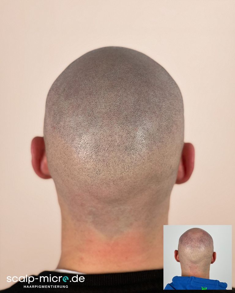 Haarpigmentierung SMP Haarpigmentation bei Haarausfall in Bersenbrück