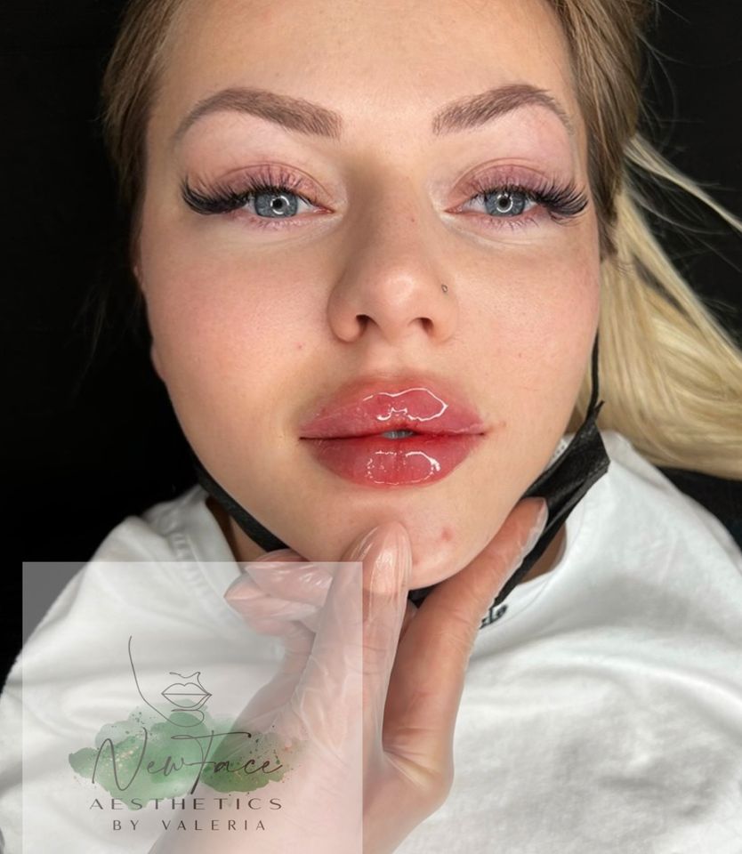 Hyaluron ,Russian Lips,Lippenunterspritzung,Nasenkorrektur, botox in Wahlstedt