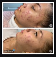 Gesichtsbehandlung BioRePeel Behandlung bei Akne Narben Poren Duisburg - Meiderich/Beeck Vorschau