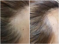 Optische Haarverdichtung, Hairline Microblading Bremen - Blumenthal Vorschau