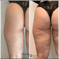 Angebot! Anti Cellulite & Wassereinlagerungen - Maderotherapie Hannover - Linden-Limmer Vorschau