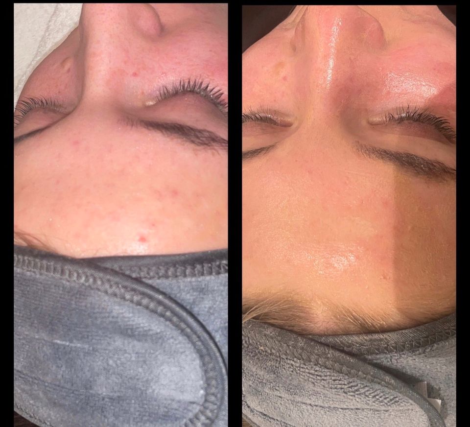 Microneedling , BB-Glow, Gesichtsbehandlung, Beauty in Melbeck in Lüneburg