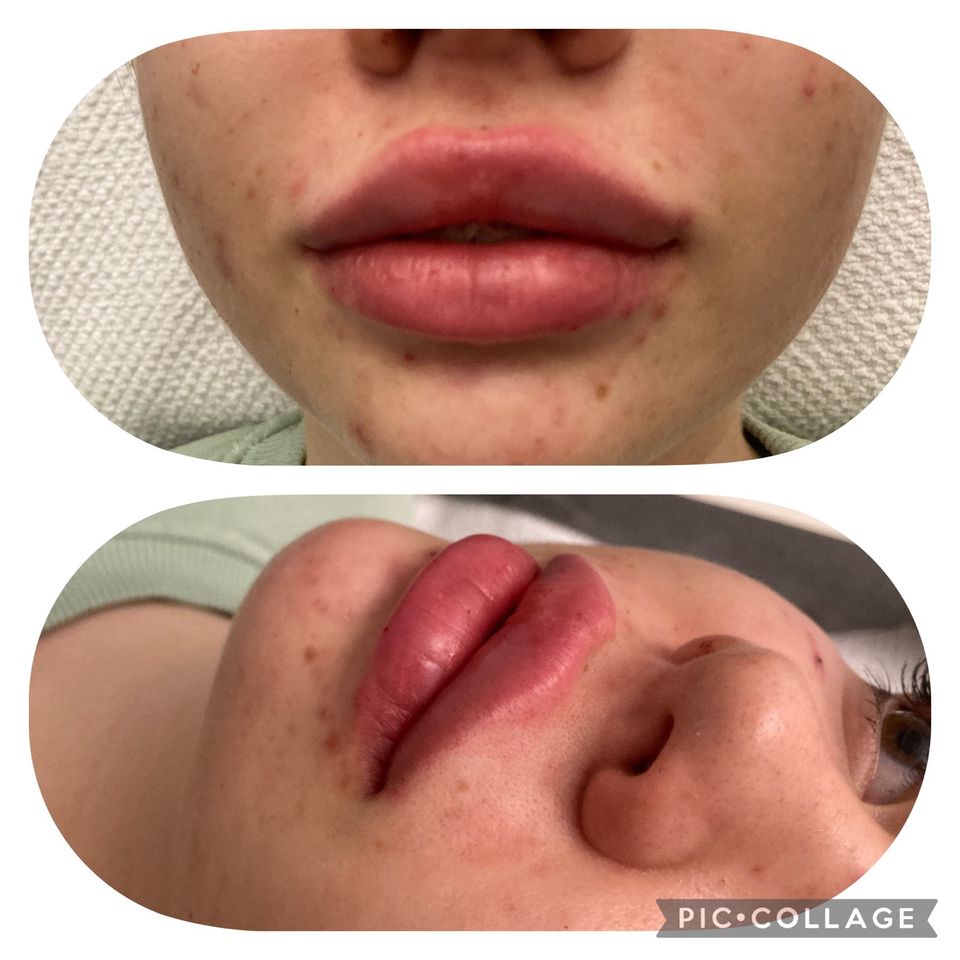 Lippen- & Faltenunterspritzung * Contouring in Hamburg