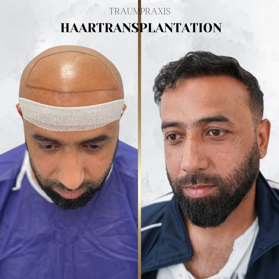 Haartransplantation in Hamburg Aktion Ab 1500€ in Hamburg