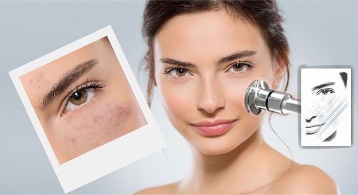 Diamant microdermabrasion gesichtsbehandlung in Düsseldorf