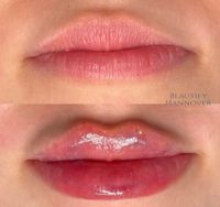 Lippenunterspritzung, Hyaluron, Russian Lips 1 ml 299€ Hannover - Döhren-Wülfel Vorschau