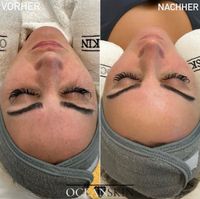 Aquafacial/ Hydrafacial und Microneedling Baden-Württemberg - Mannheim Vorschau