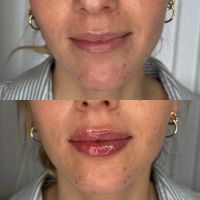 Lippenunterspritzung, Lemon Bottle, Mesotherapie, DripSpa Dithmarschen - Marne Vorschau