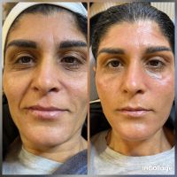 Gesichtsreinigung + Microneedling + BB Glow Saarland - Marpingen Vorschau