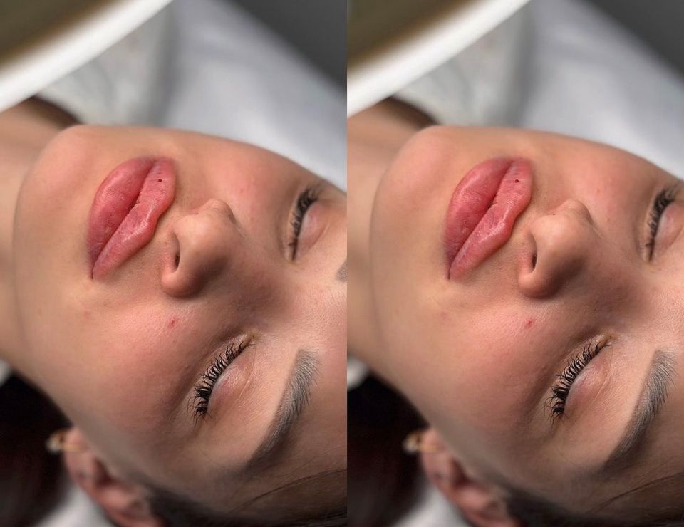 Russianlips Lippenunterspritzung Botox in Hamburg