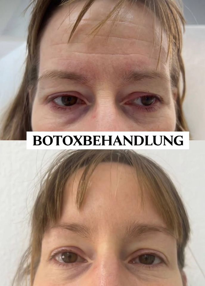 Botox durch Fachärztin in Frechen