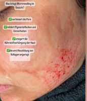 Microneedling Häfen - Bremerhaven Vorschau