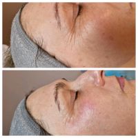 Falten,  Microneedling,  Anti Aging,  Schönheit,  Kosmetik Niedersachsen - Osnabrück Vorschau