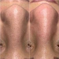 Microneedling BB Glow Aqua Facial Schulung mobil Dortmund - Innenstadt-Ost Vorschau