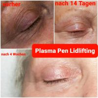 Plasma Pen Behandlung Nordrhein-Westfalen - Oberhausen Vorschau