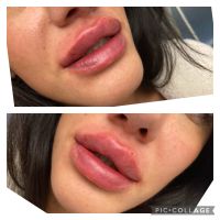 RUSSIAN-LIPS * Lippenunterspritzung Hamburg-Mitte - Hamburg Neustadt Vorschau