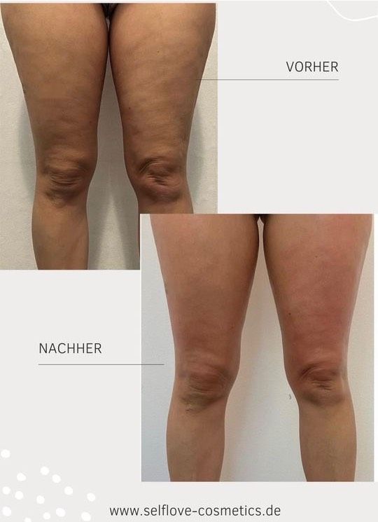 G5 Massage Bodyformer Abnehmen Fettreduktion Cellulite Behandlung in Witten